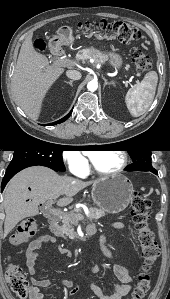 Chronic Pancreatitis Simulates a Mass