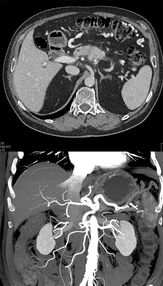 Detection of Pancreatic Cancer