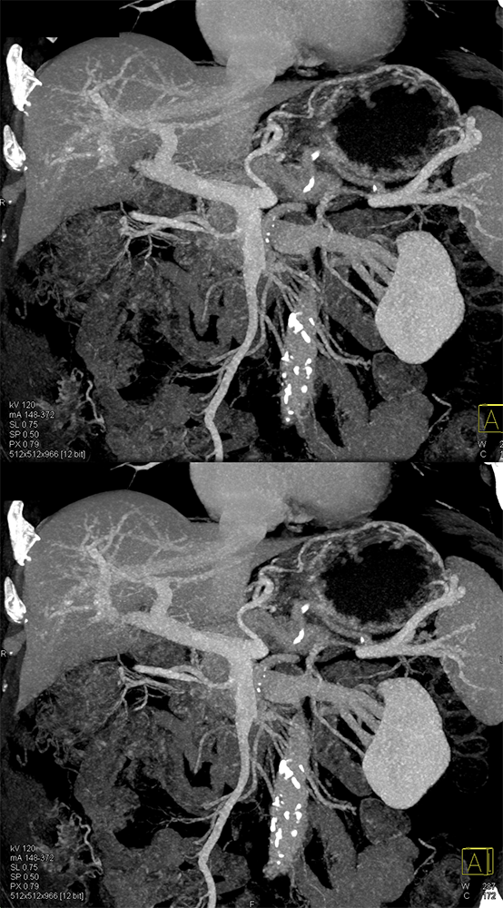 Detection of Pancreatic Cancer