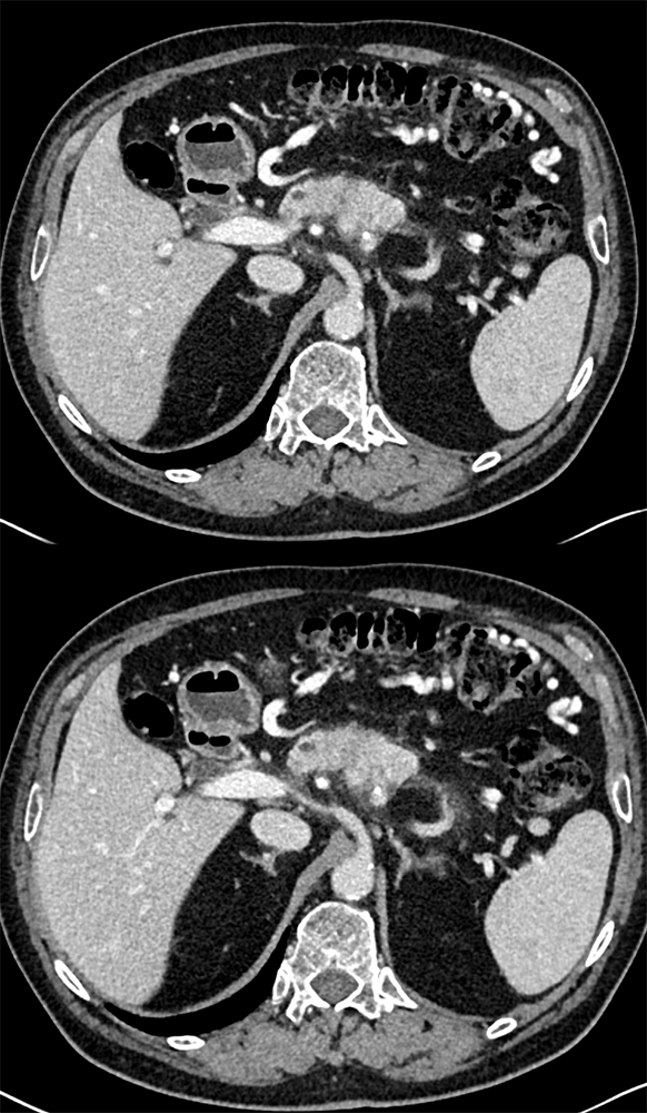 Detection of Pancreatic Cancer