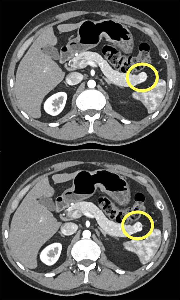 PNET Tail of Pancreas 1cm