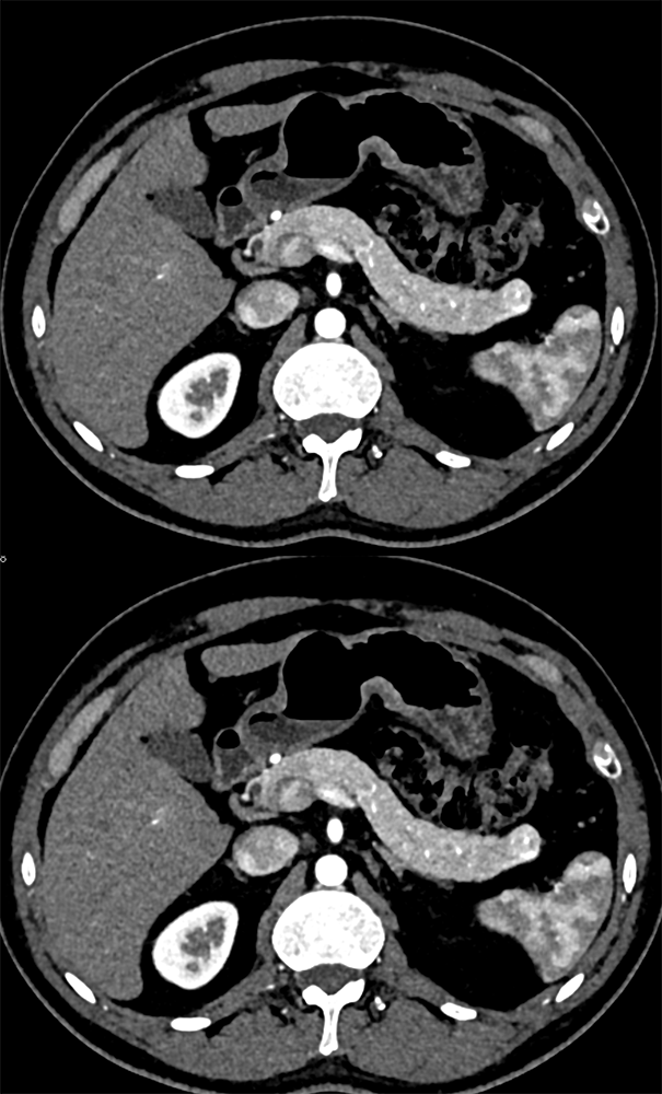 Detection of Pancreatic Cancer