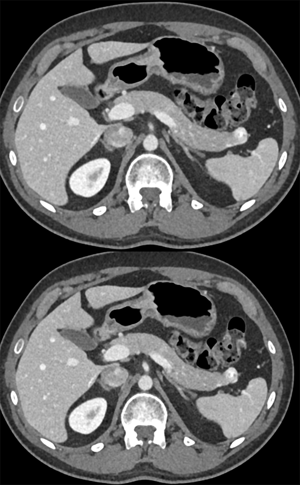 Detection of Pancreatic Cancer