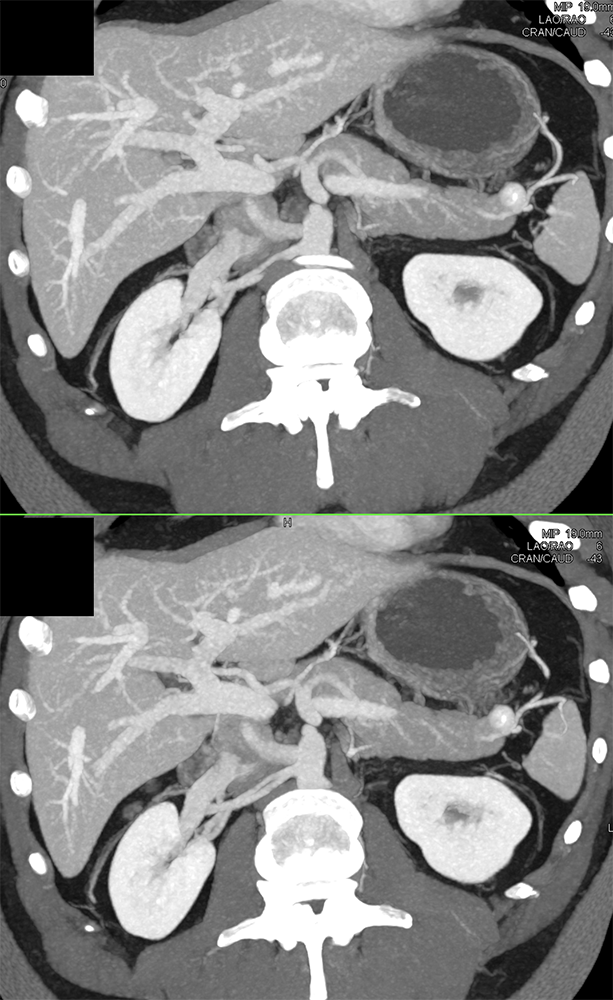 Detection of Pancreatic Cancer