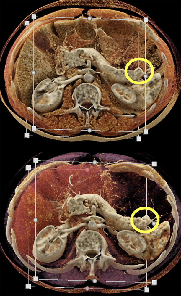 Detection of Pancreatic Cancer