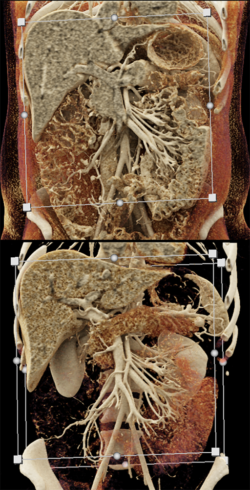 Detection of Pancreatic Cancer