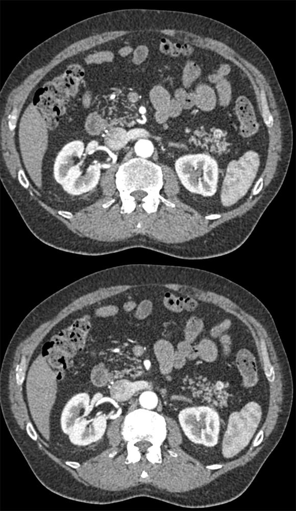 Neuroendocrine Tumor TOP