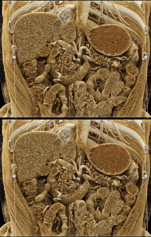 Detection of Pancreatic Cancer