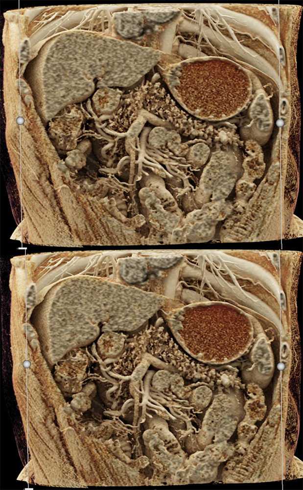 Detection of Pancreatic Cancer