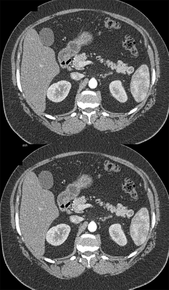 PNET Tail of the Pancreas