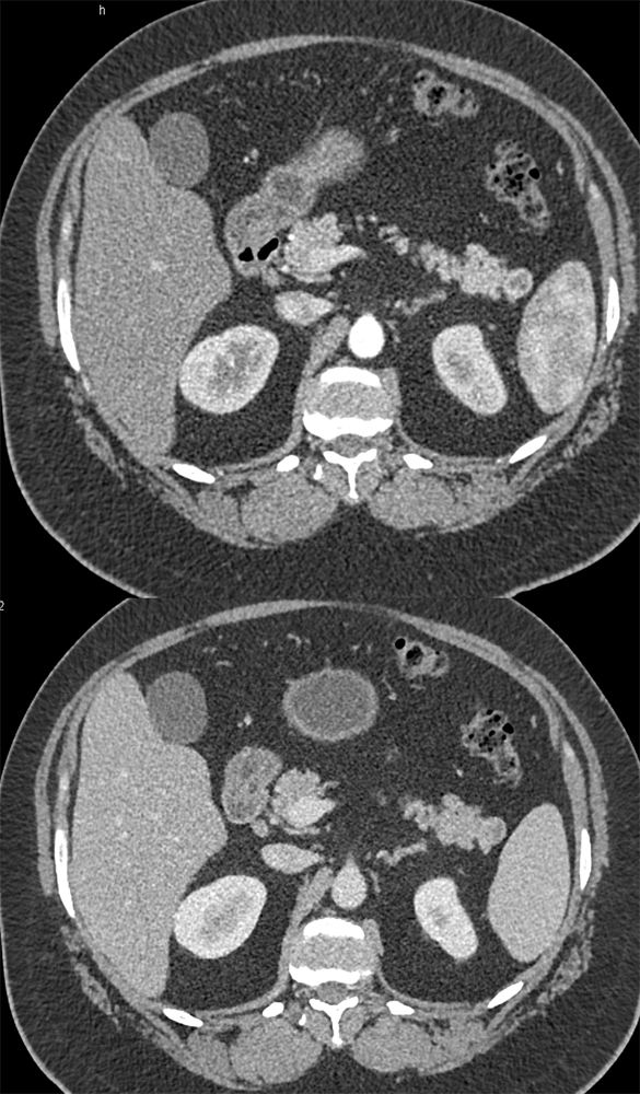 Detection of Pancreatic Cancer