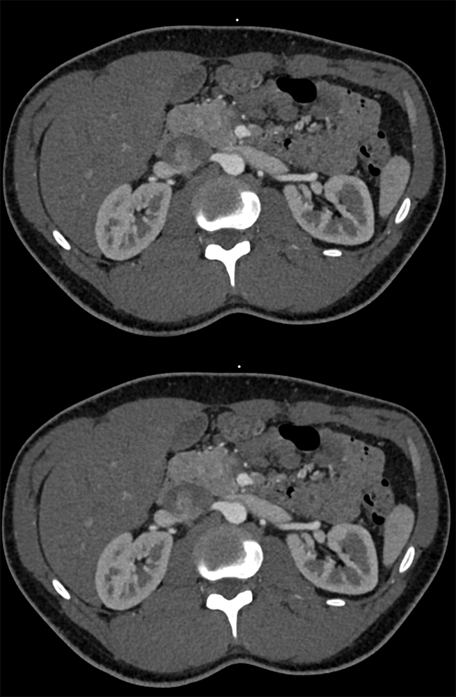 Incidental PNET in Head of Pancreas (subtle on coronal)