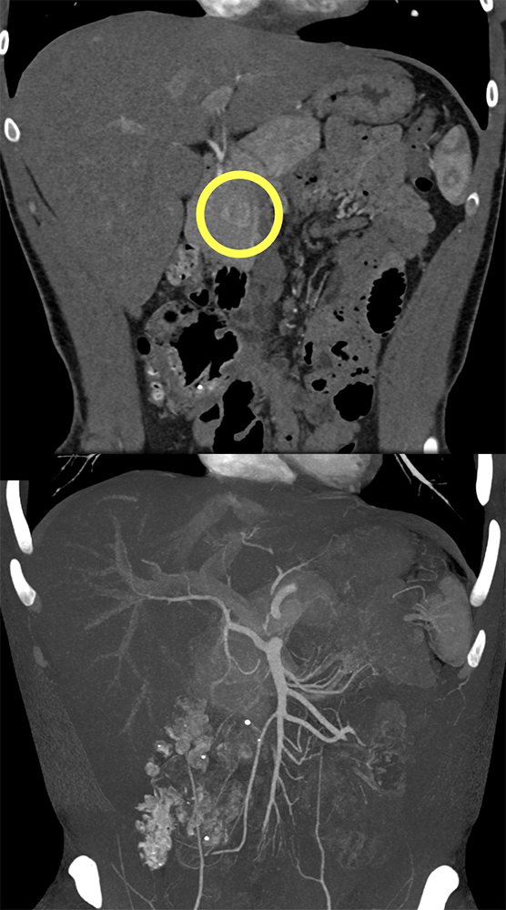 Detection of Pancreatic Cancer