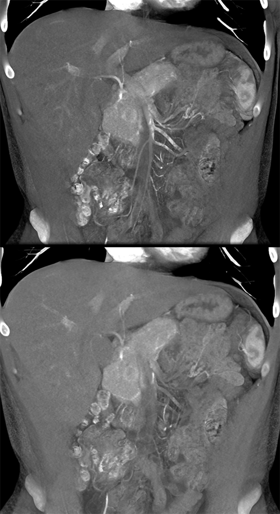 Detection of Pancreatic Cancer