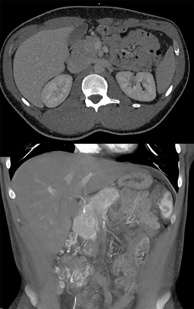 Detection of Pancreatic Cancer