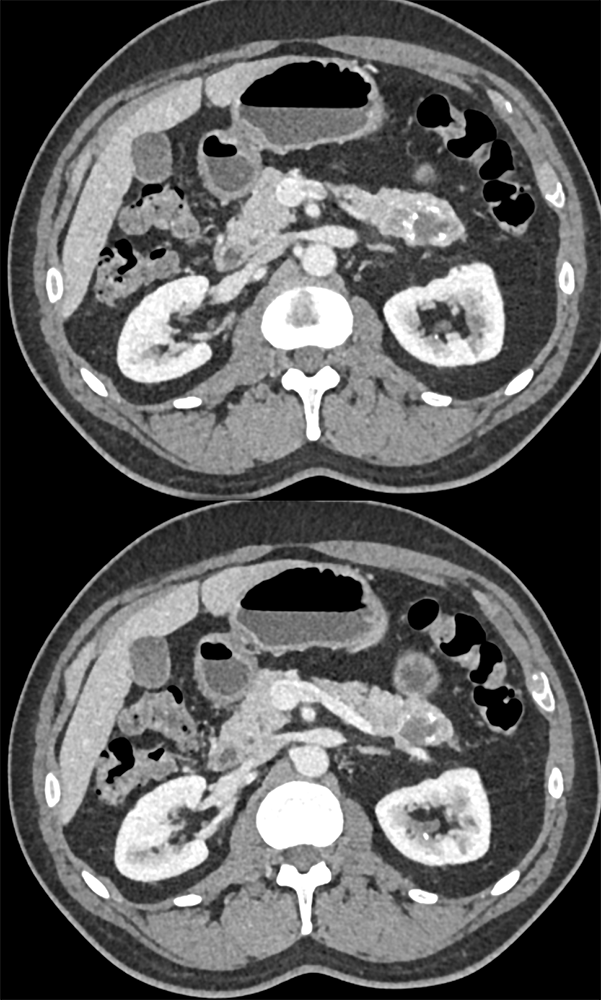 SPEN Tumor with CR