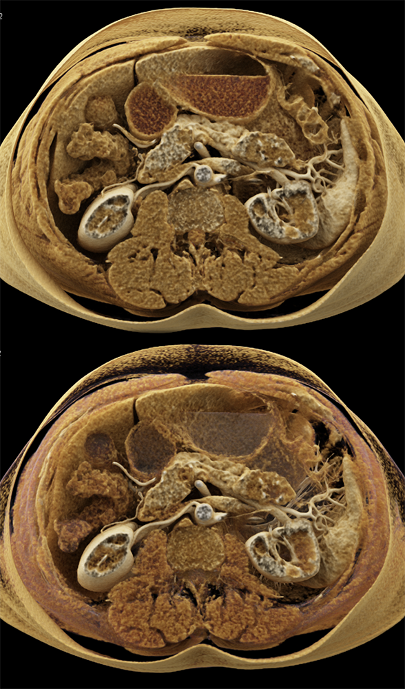 Detection of Pancreatic Cancer