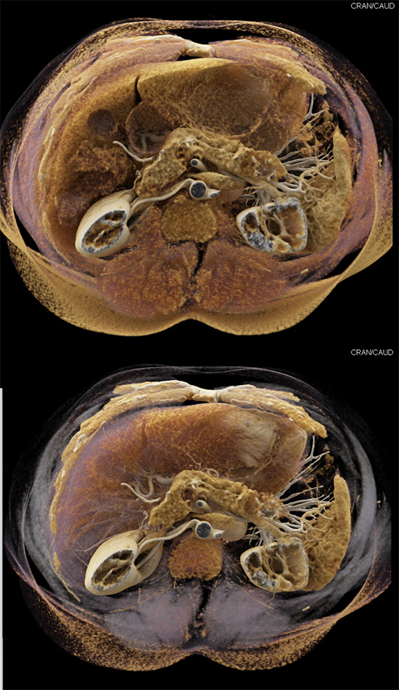 Detection of Pancreatic Cancer