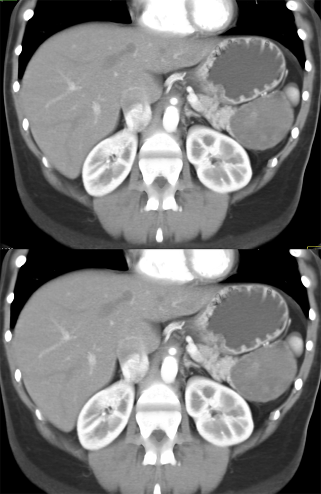 Detection of Pancreatic Cancer