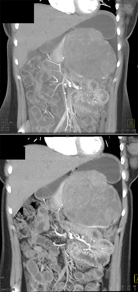 Detection of Pancreatic Cancer