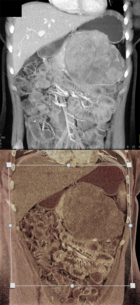 Detection of Pancreatic Cancer