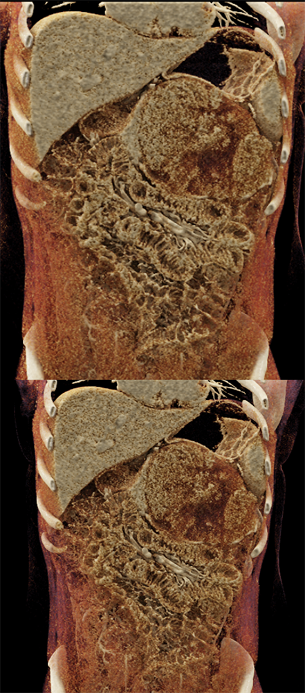 Detection of Pancreatic Cancer