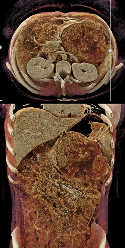 Detection of Pancreatic Cancer