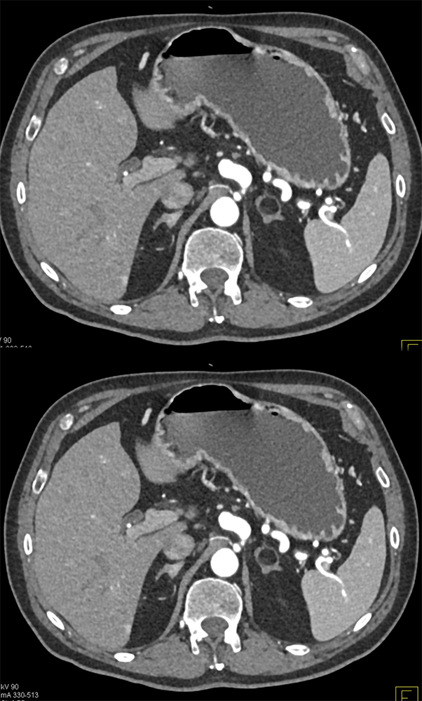 Pancreatic Adenocarcinoma and Incidental Pheo