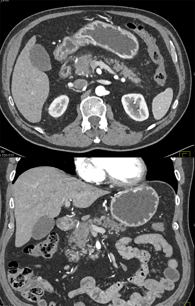 Detection of Pancreatic Cancer