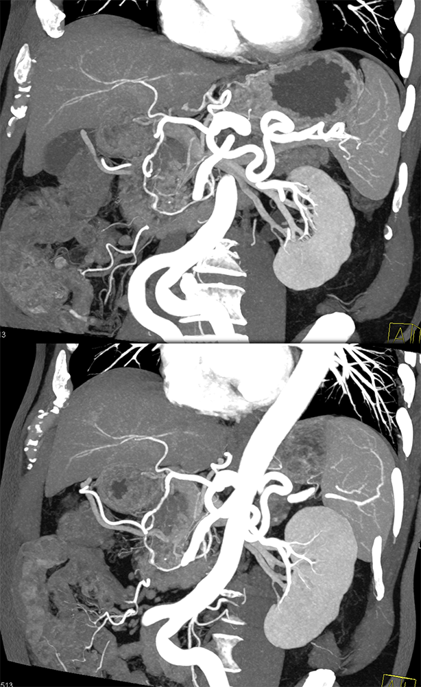 Detection of Pancreatic Cancer