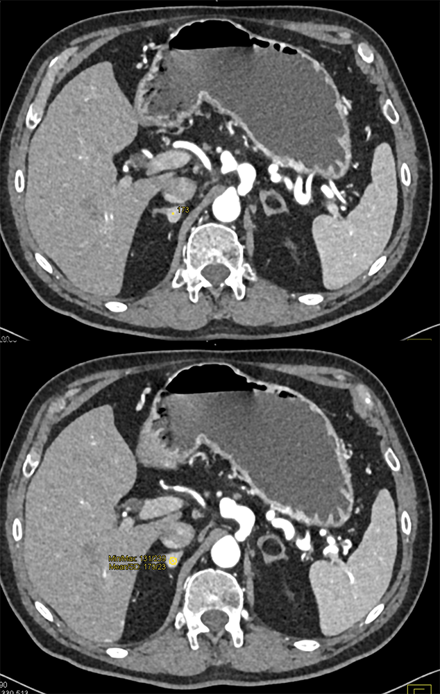 Detection of Pancreatic Cancer