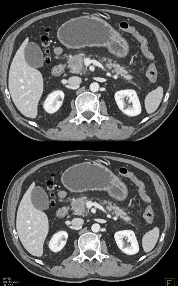 Detection of Pancreatic Cancer