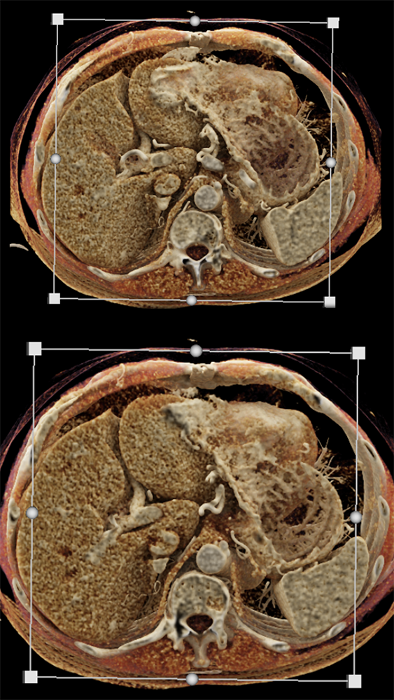 Detection of Pancreatic Cancer