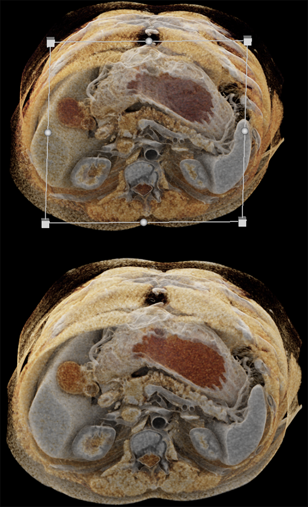 Detection of Pancreatic Cancer