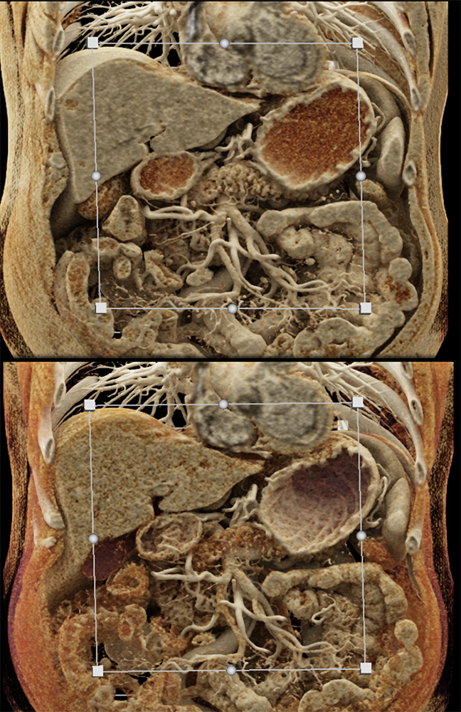 Detection of Pancreatic Cancer