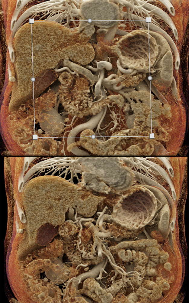 Detection of Pancreatic Cancer