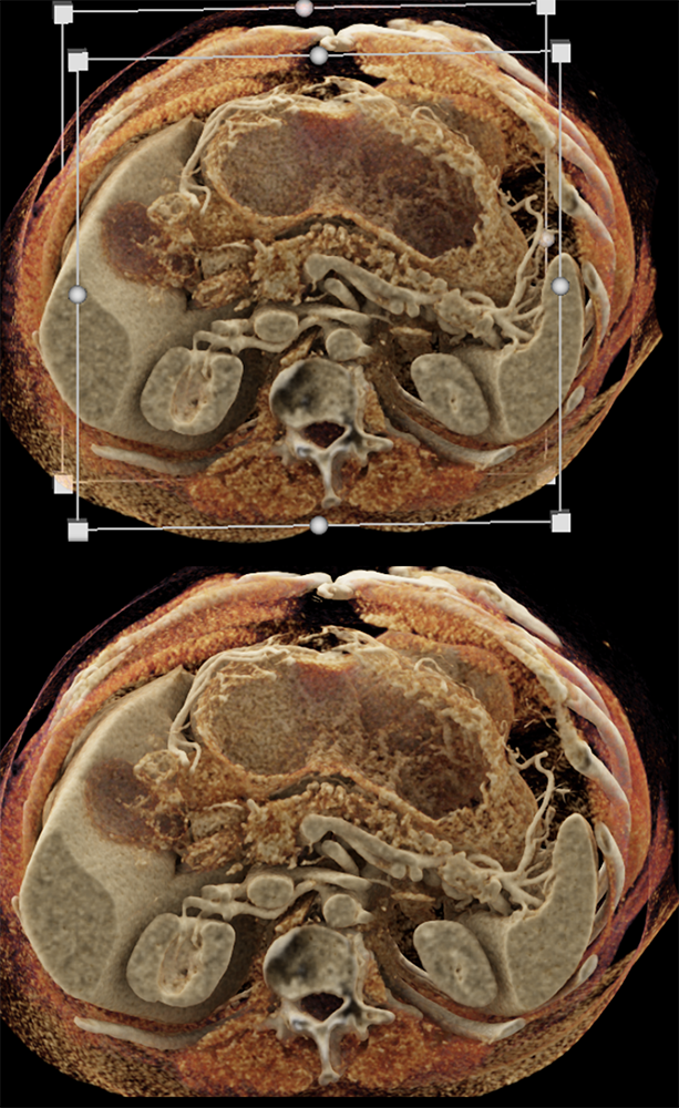 Detection of Pancreatic Cancer