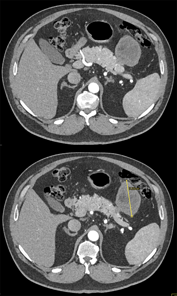 Omental Infarct Simulates Recurrent Tumor