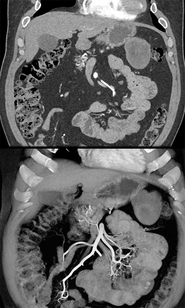 Detection of Pancreatic Cancer