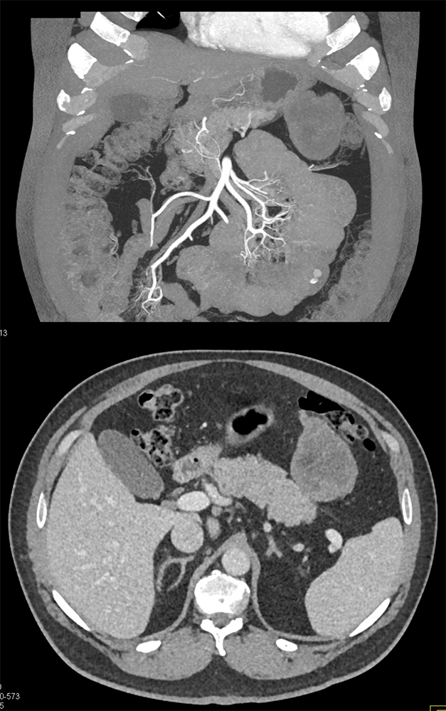 Detection of Pancreatic Cancer