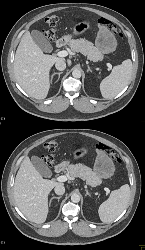 Detection of Pancreatic Cancer