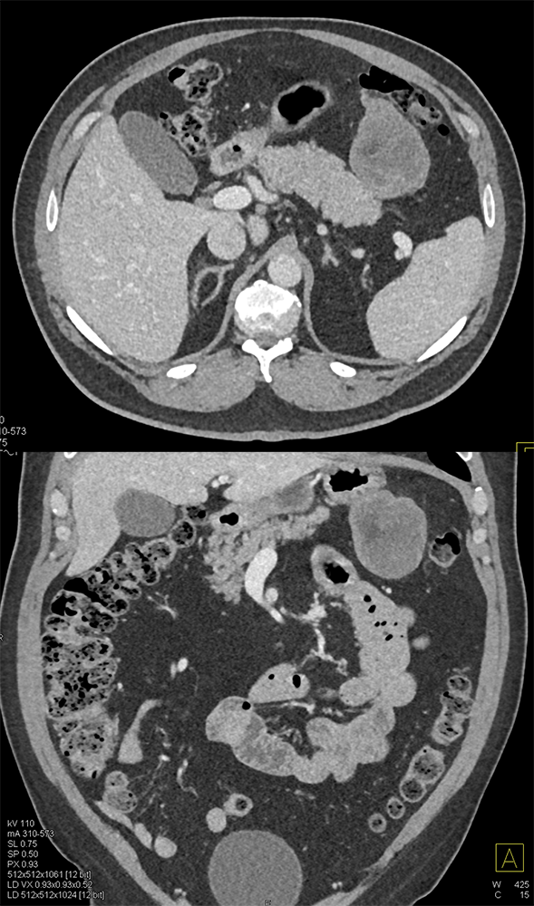 Detection of Pancreatic Cancer