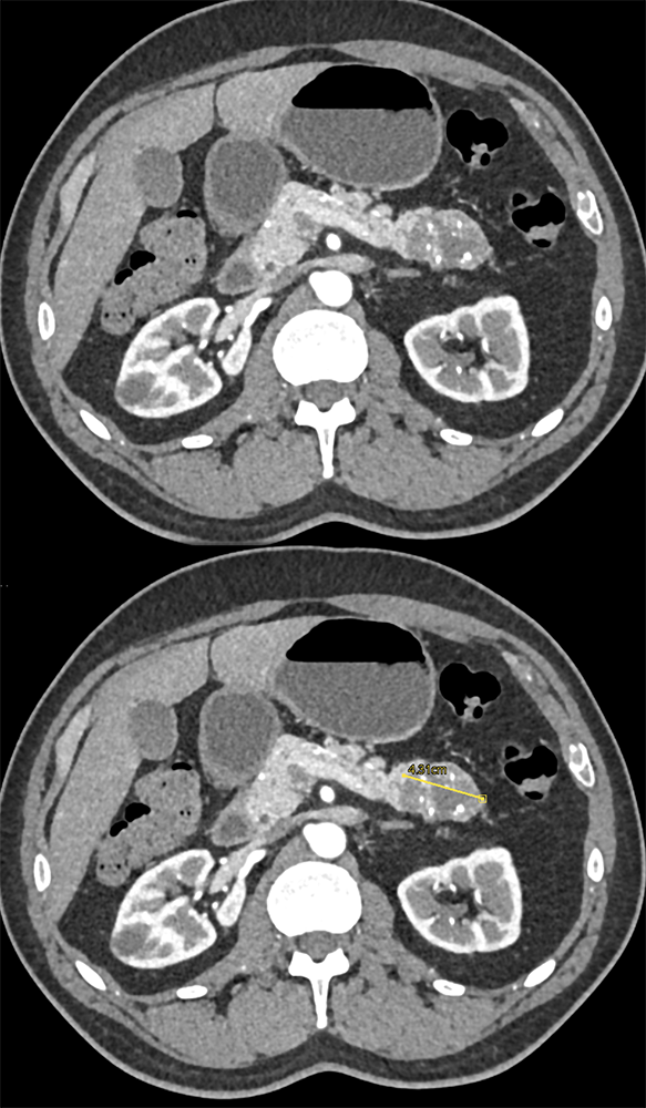 SPEN Tumor with CR