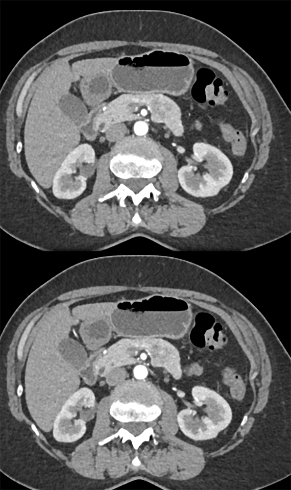 Unusual Serous Cystadenoma