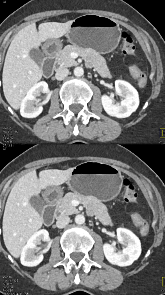 Detection of Pancreatic Cancer