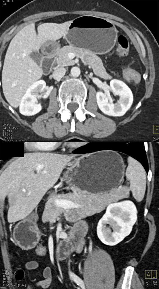 Detection of Pancreatic Cancer