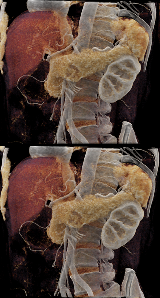 Detection of Pancreatic Cancer