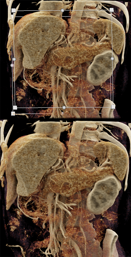 Detection of Pancreatic Cancer