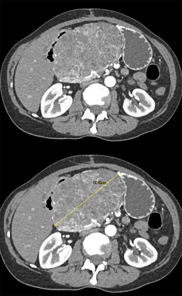 Serous Cystadenoma