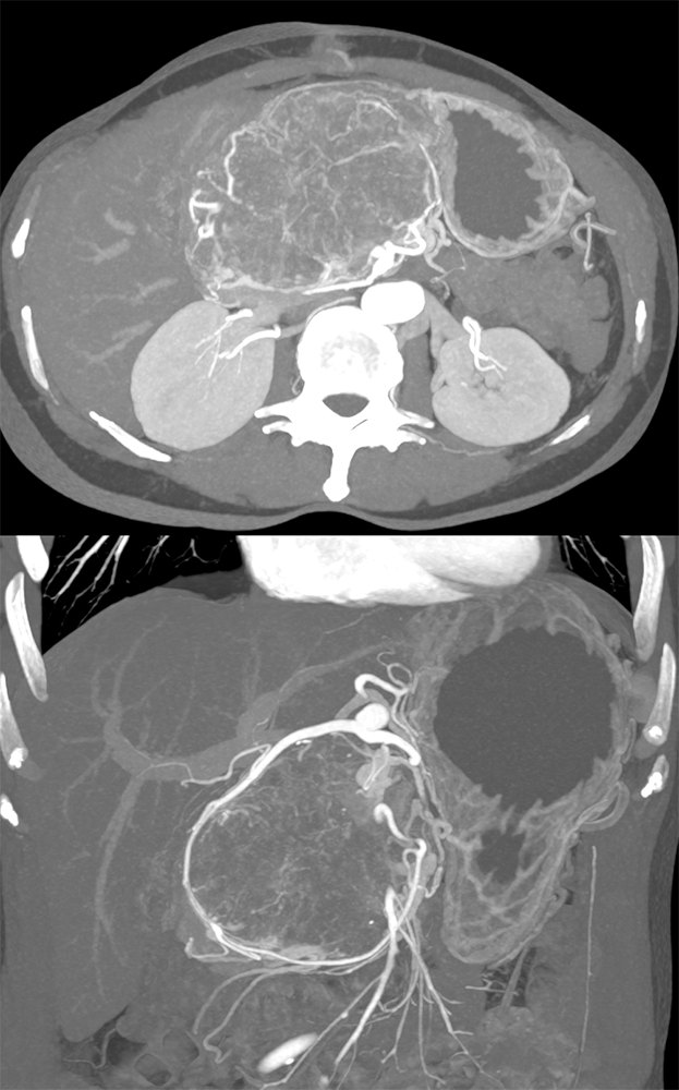 Detection of Pancreatic Cancer